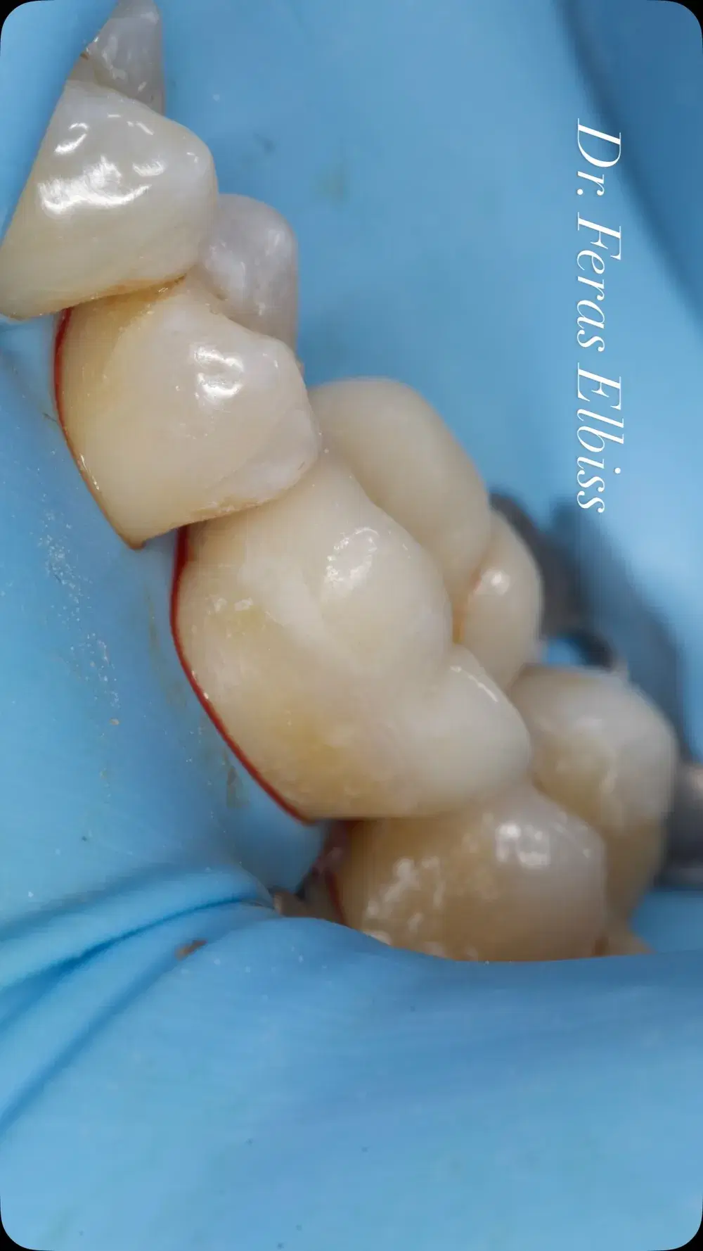 Adhesive overlay where a full crown would be unnecessarily invasive