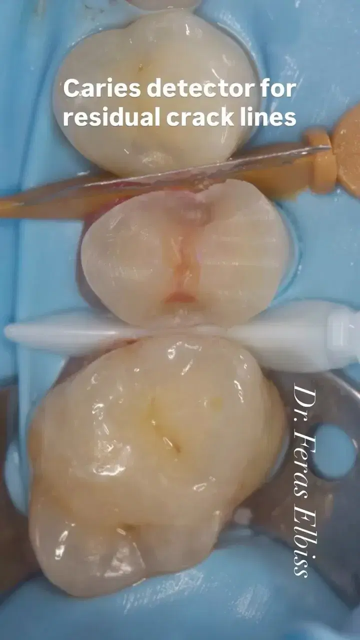 Cracked premolar restored with an adhesive approach