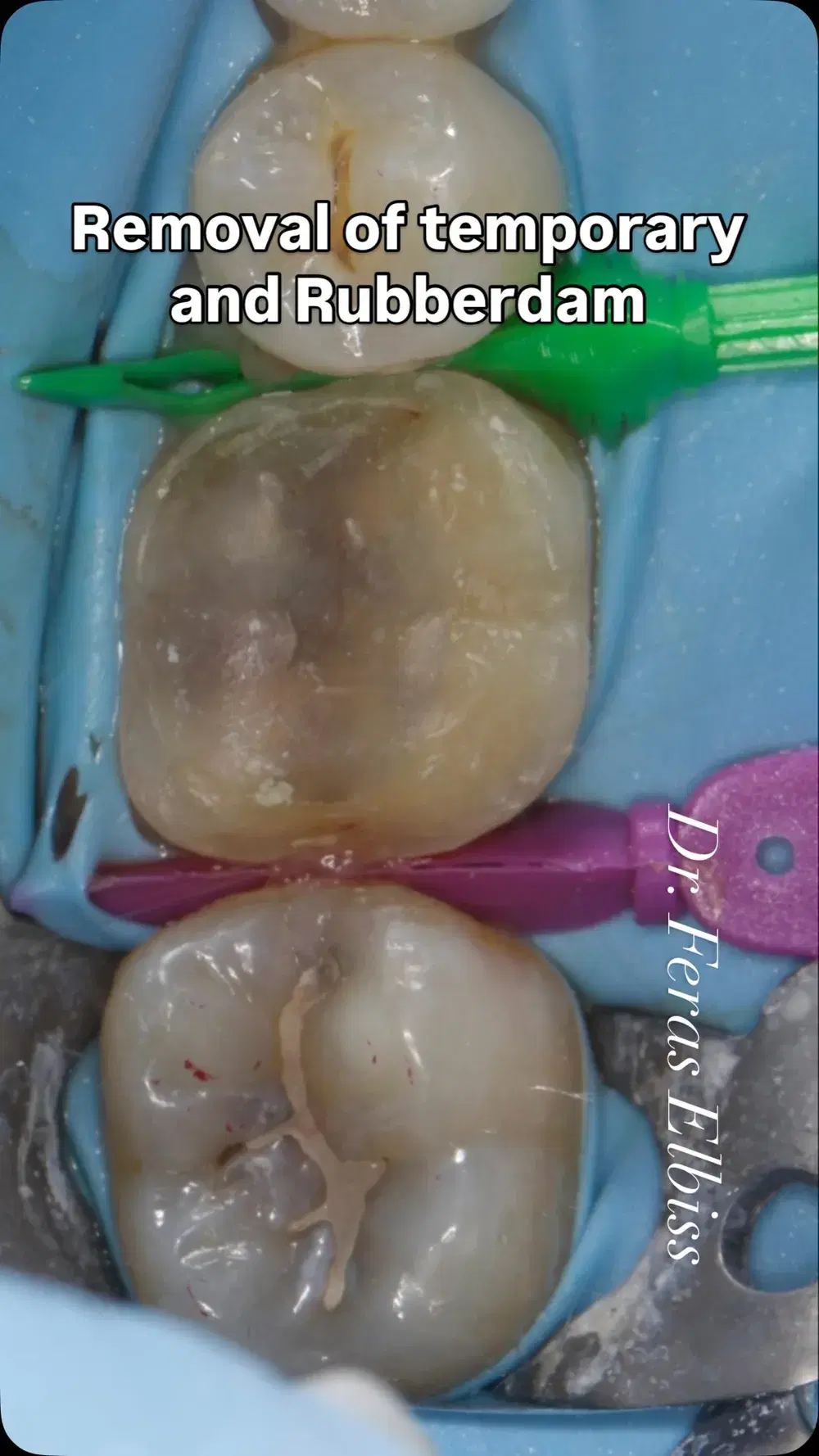 Emax onlay fit with composite restoration