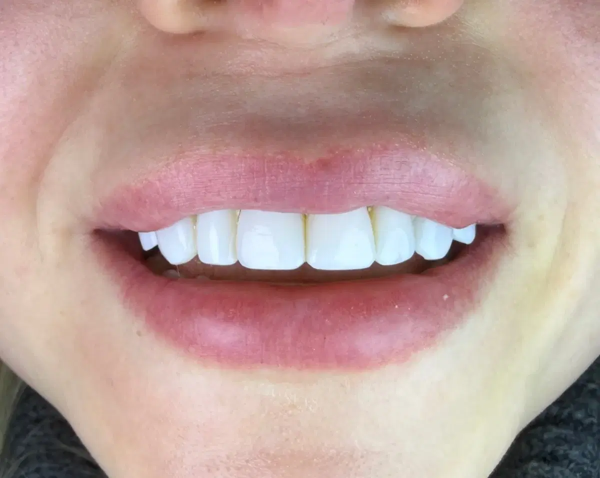 After composite veneers by Dr Amir: even, polished upper front teeth