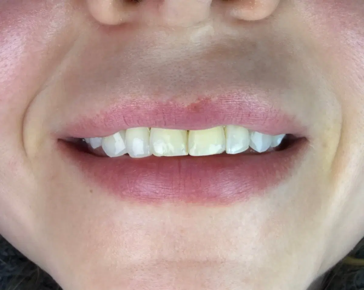 Before composite veneers: uneven edges and shade on the upper front teeth