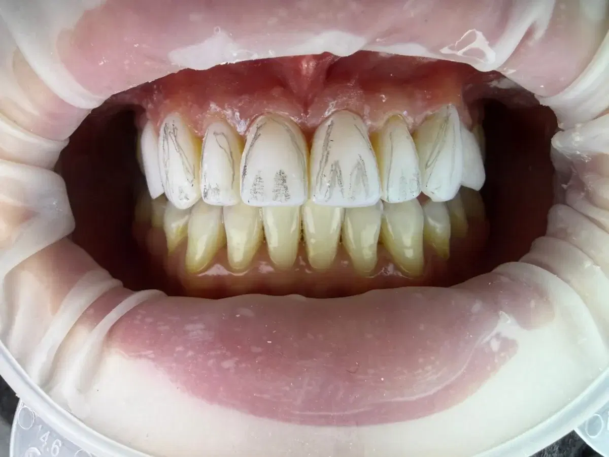 Composite veneers before polishing, with pencil marks mapping the line angles and surface texture
