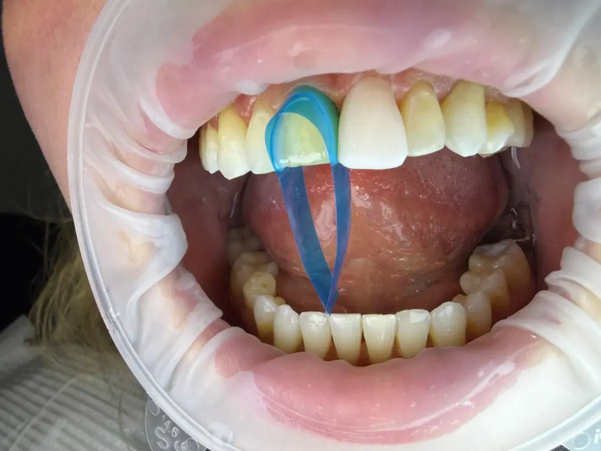 A composite veneer being sculpted on an upper front tooth, with a matrix strip between the teeth