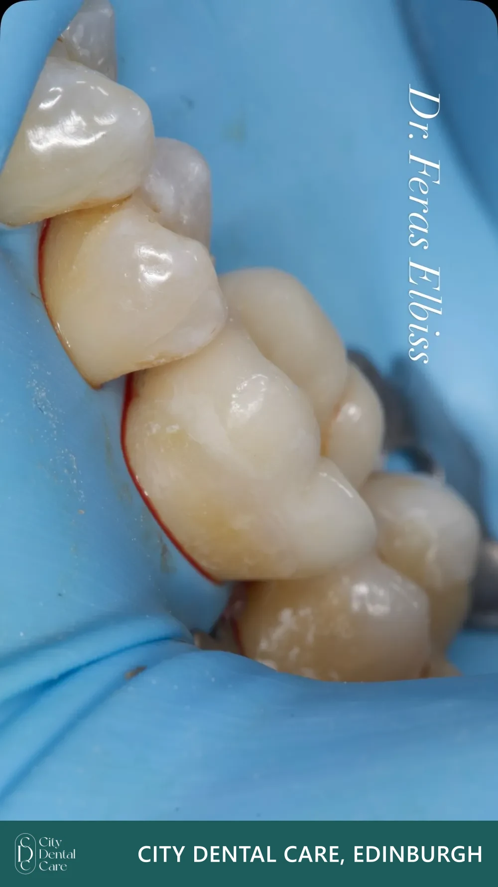 Adhesive Onlay — Dr. Feras Elbiss