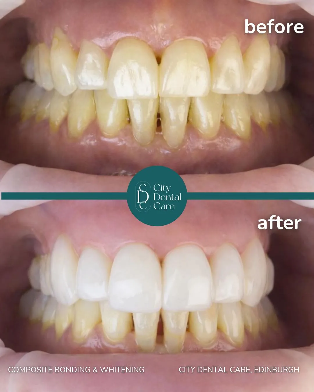 Before and after composite bonding with teeth whitening - a City Dental Care patient