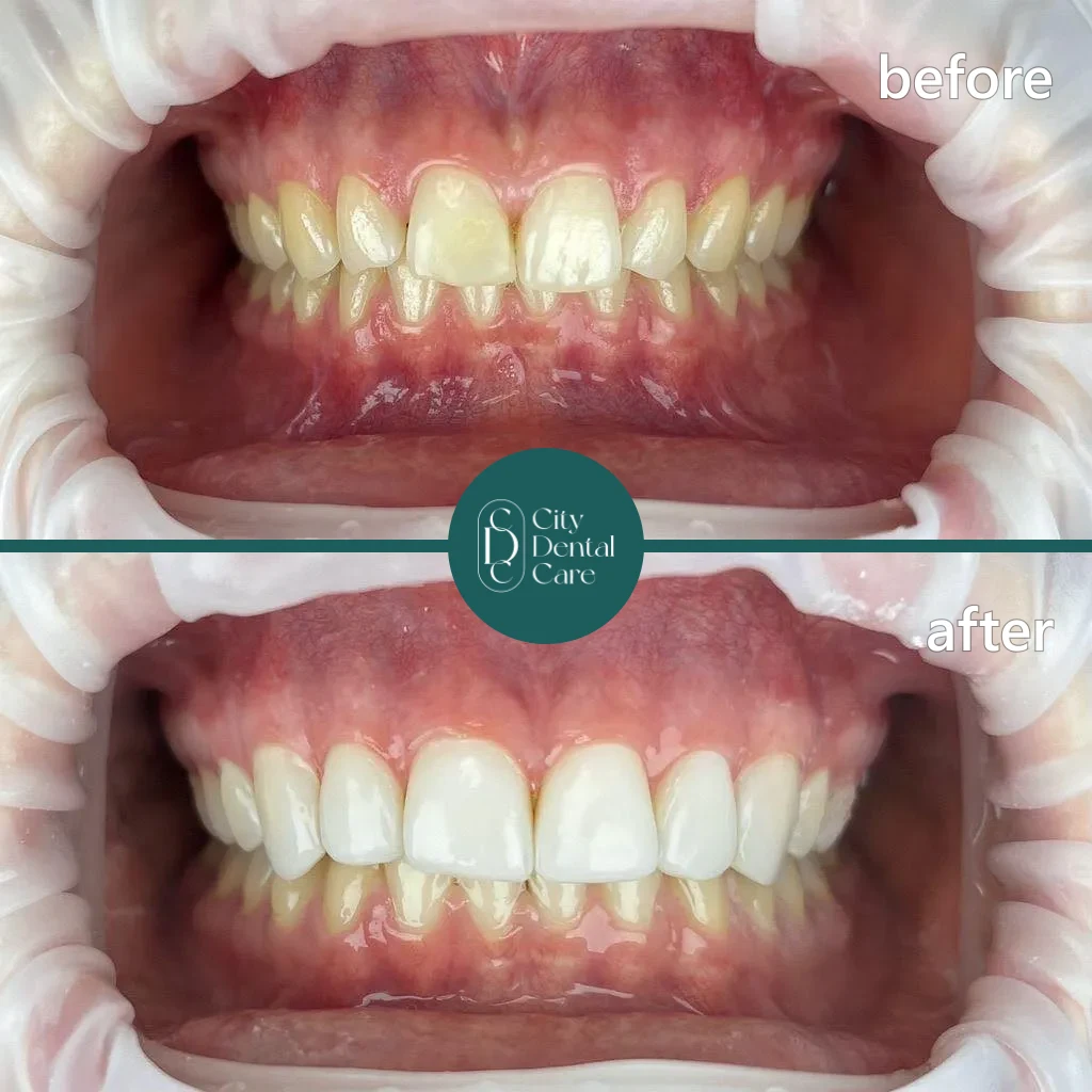 Composite bonding before and after - a City Dental Care patient