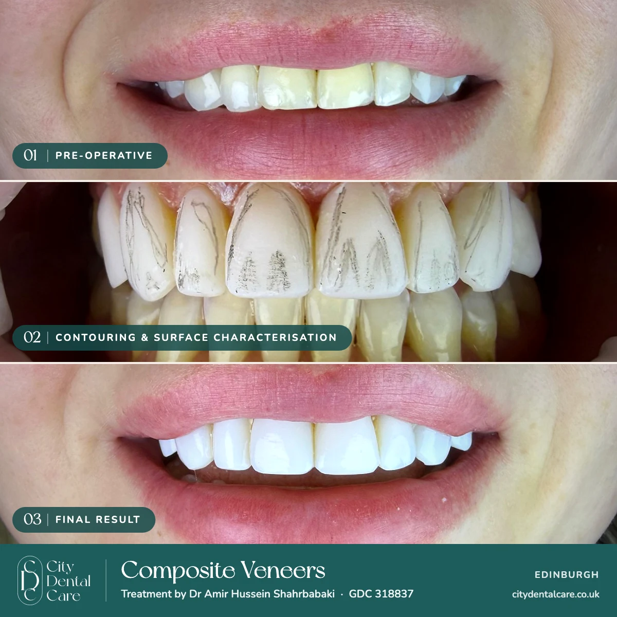 Composite Veneers Smile Journey — Dr. Amir