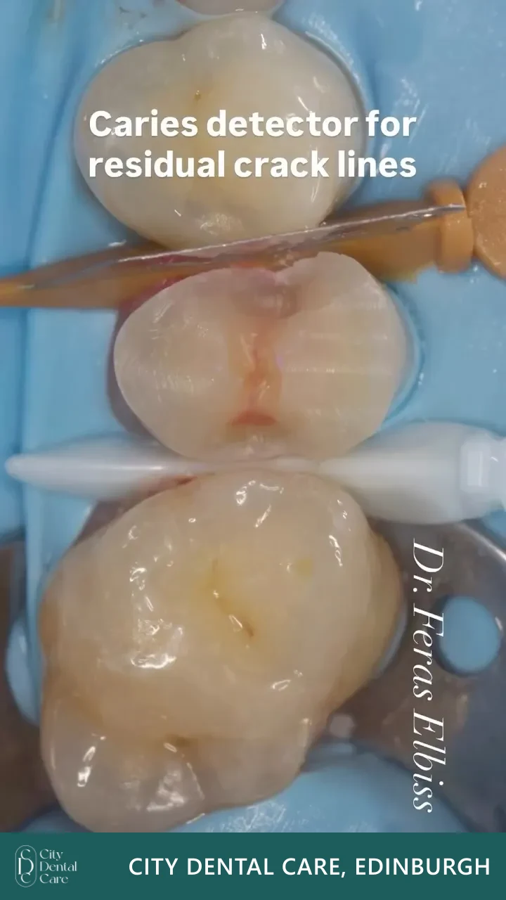 Cracked tooth isolated under rubber dam, with detector dye showing the crack lines - a City Dental Care patient
