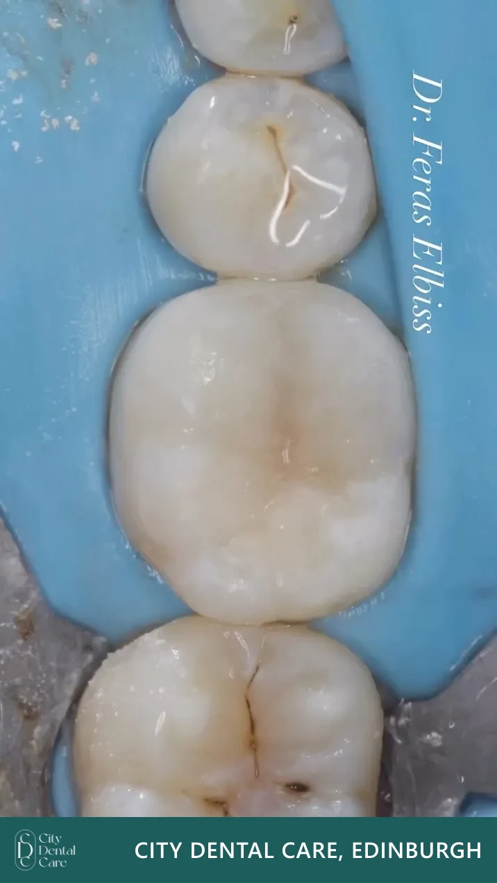 White filling on a back tooth - a City Dental Care patient