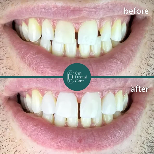 Smile transformation before and after - a City Dental Care patient