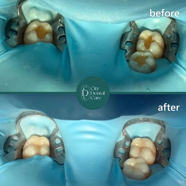 White fillings on back teeth, before and after - a City Dental Care patient